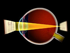 Light focuses in front of the retina causing blurry distance vision