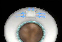 FiltrationSurgeryPerformed
