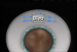 A small channel or ‘bleb’ is created to allow fluid to drain from the eye. (See animation below.)