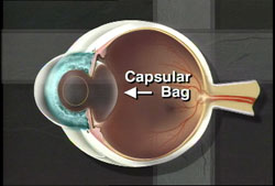 The capsular bag can become cloudy over time.