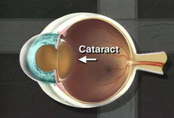 Cataract