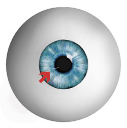 A corneal abrasion is simply a scratch in the outer layer of the cornea