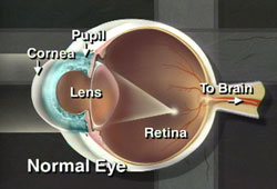 If there is a break or defect in the surface layer of the cornea, a corneal ulcer results