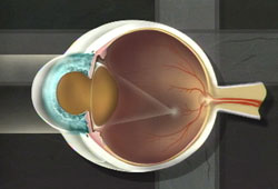 Intra-OcularLens