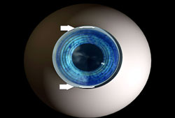 Pre-existing astigmatism can be treated with limbal relaxing incisions.