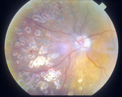 Pan Retinal Photocoagulation stops vessels on the retina from leaking