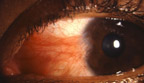 Pterygium