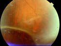 RetinalDetachment